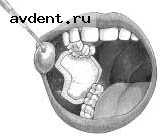 Прокладки Dry Tips (Largе) для поглощения слюны, 50 штMolnlycke HealthCare Прокладки Dry Tips (Largе) для поглощения слюны, 50 штMolnlycke HealthCare